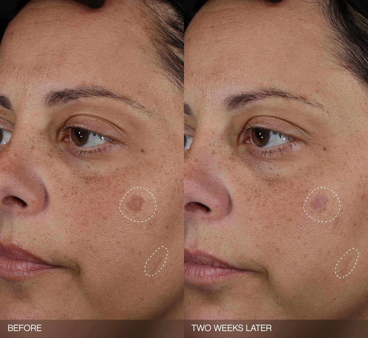 Faded Dark Spot Patches