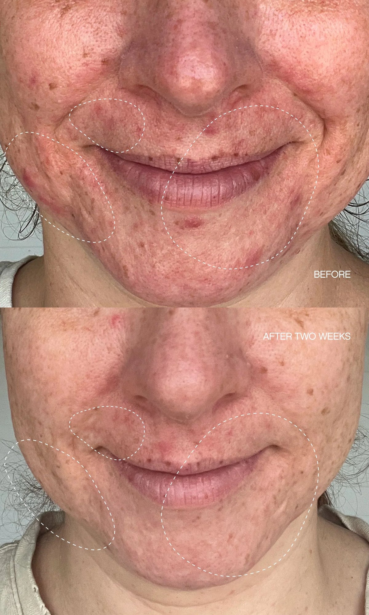 Clearly Blemish Mask